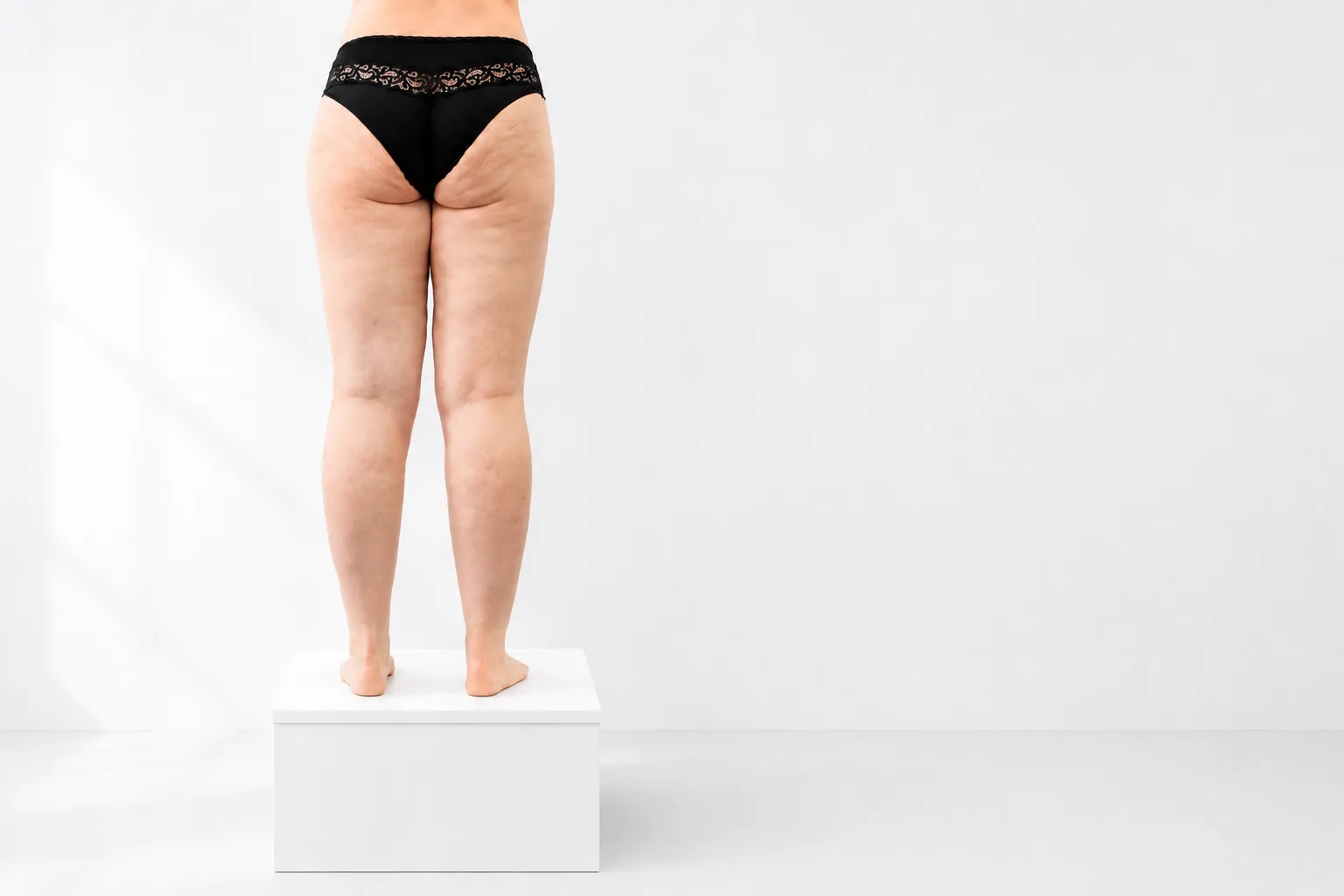 Rückansicht der Beine einer Patientin mit Lipödem